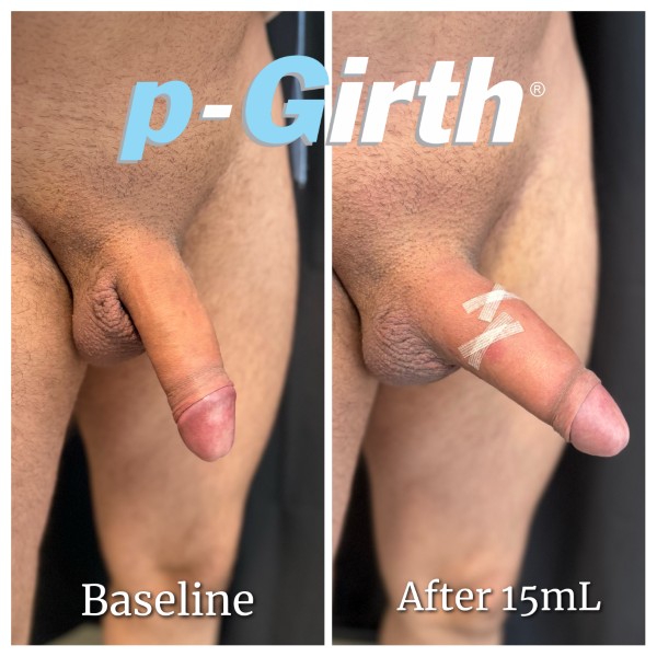 P-Girth® Uncircumcised penis augmentation case 11