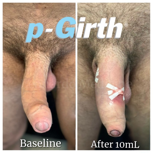 P-Girth® Uncircumcised penis augmentation case 12