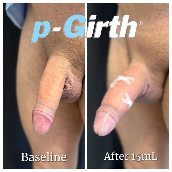P-Girth® Uncircumcised penis augmentation case 13