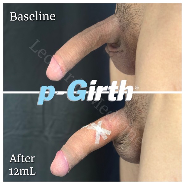 P-Girth® Uncircumcised penis augmentation case 14