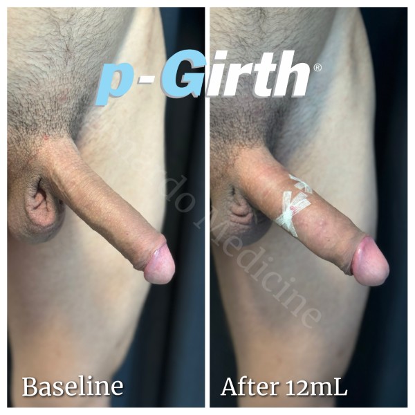 P-Girth® Uncircumcised penis augmentation case 15