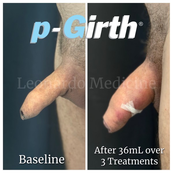 P-Girth® Uncircumcised penis augmentation case 16
