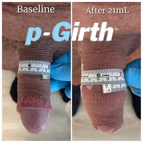 P-Girth® Uncircumcised penis augmentation case 17