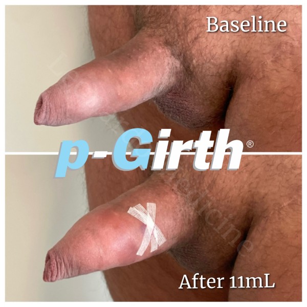 P-Girth® Uncircumcised penis augmentation case 18