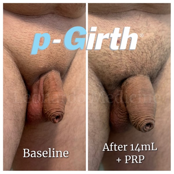 P-Girth® Uncircumcised penis augmentation case 19