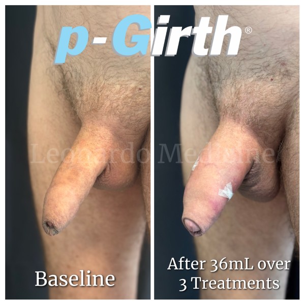 P-Girth® Uncircumcised penis augmentation case 20