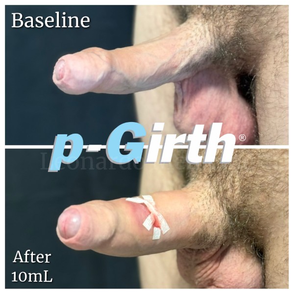 P-Girth® Uncircumcised penis augmentation case 21