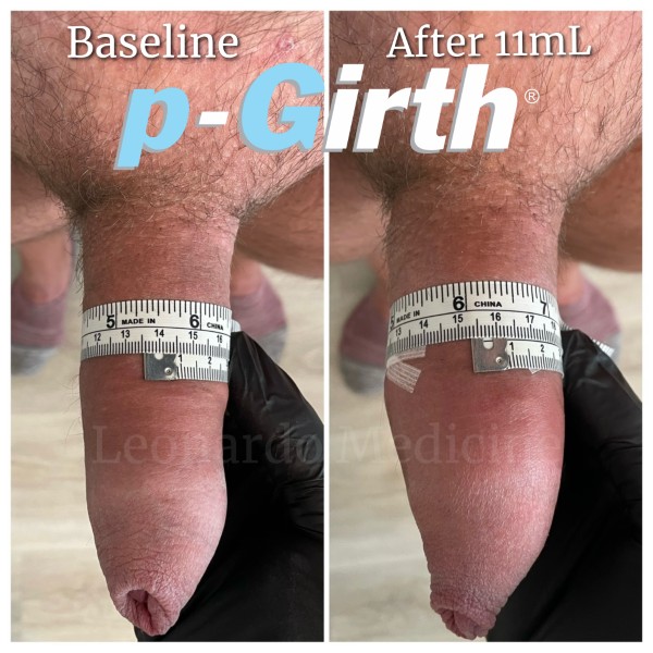 P-Girth® Uncircumcised penis augmentation case 22