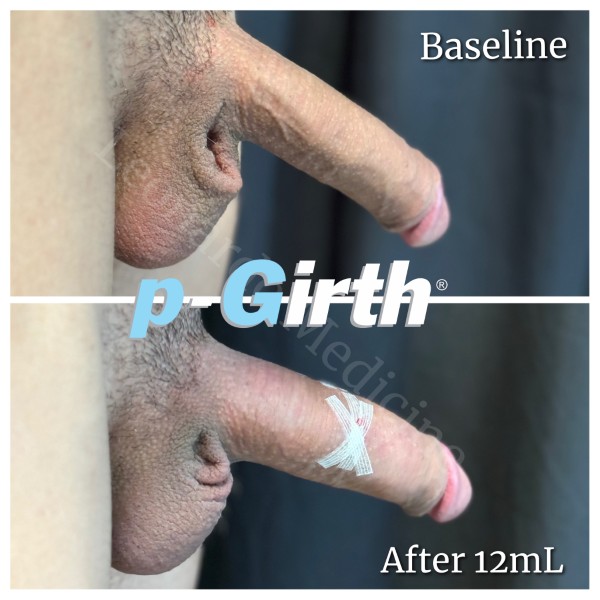 P-Girth® Uncircumcised penis augmentation case 23