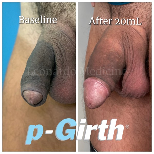 P-Girth® Uncircumcised penis augmentation case 24