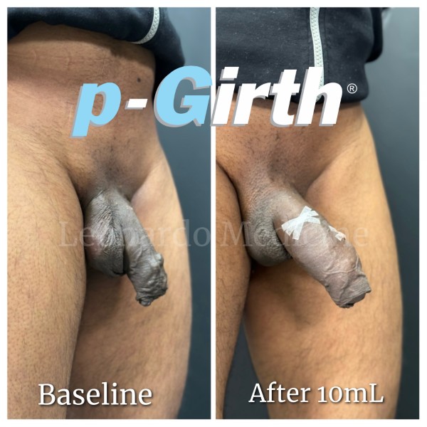 P-Girth® Uncircumcised penis augmentation case 26