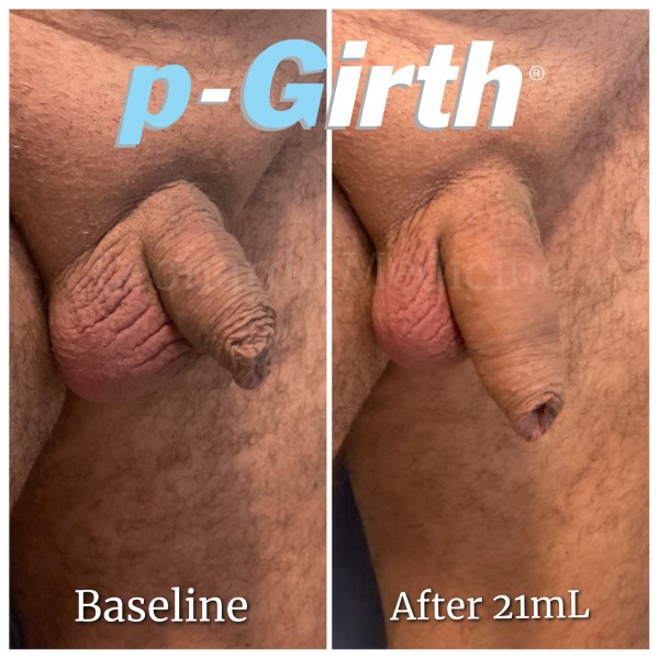 P-Girth® Uncircumcised penis augmentation case 27