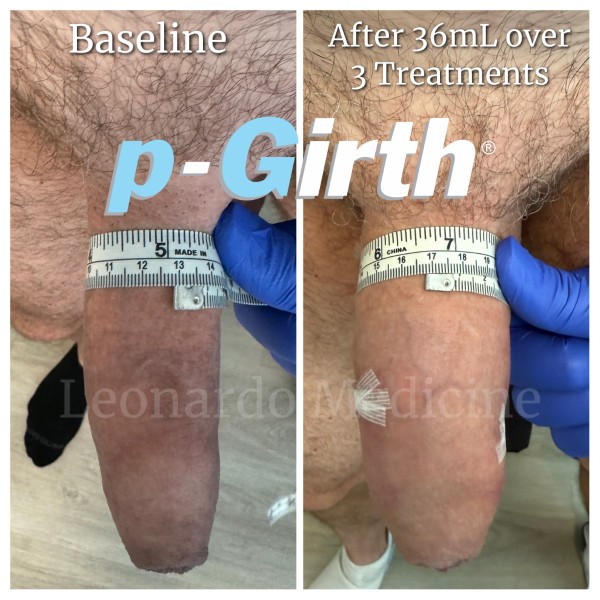 P-Girth® Uncircumcised penis augmentation case 28