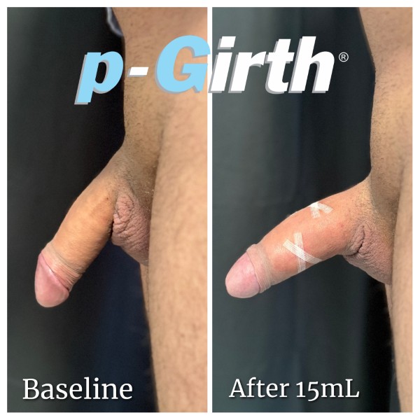 P-Girth® Uncircumcised penis augmentation case 29
