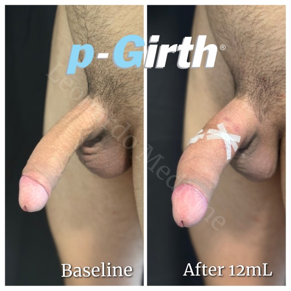 P-Girth® Uncircumcised penis augmentation case 3