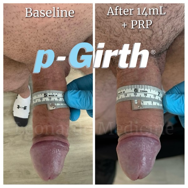 P-Girth® Uncircumcised penis augmentation case 30