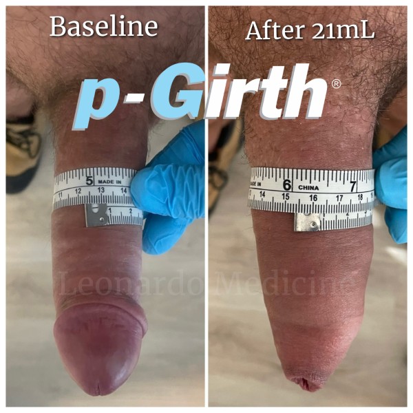 P-Girth® Uncircumcised penis augmentation case 31