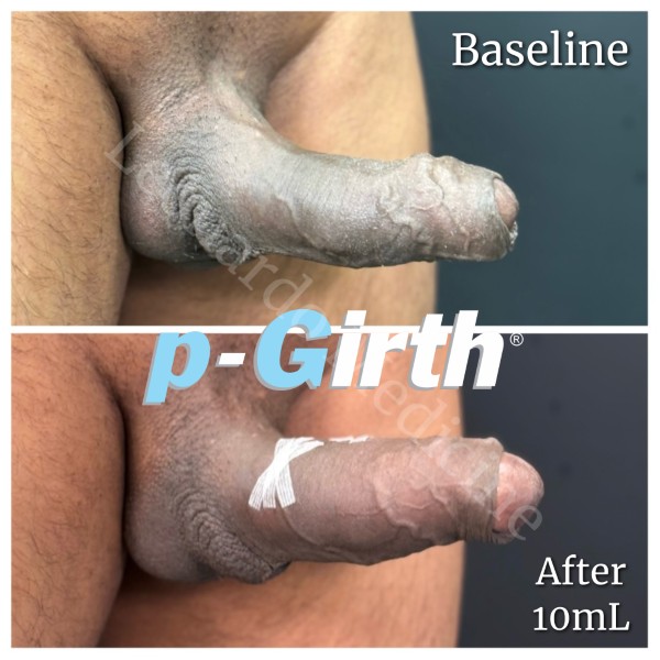P-Girth® Uncircumcised penis augmentation case 32