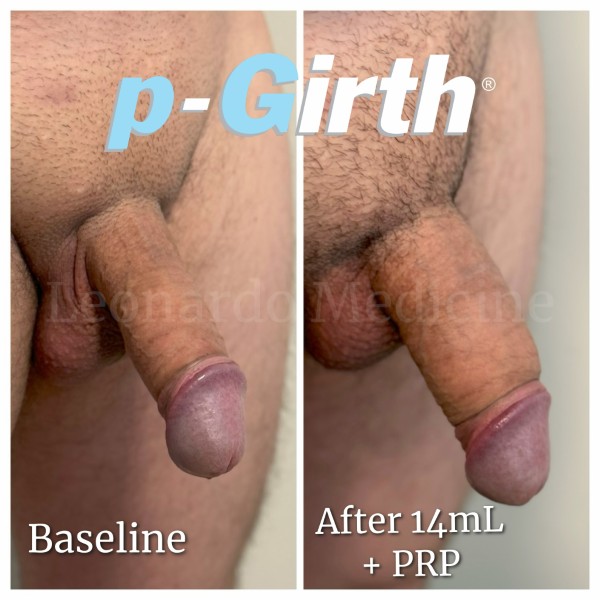 P-Girth® Uncircumcised penis augmentation case 33