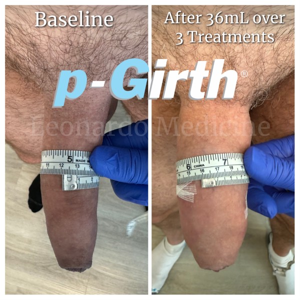 P-Girth® Uncircumcised penis augmentation case 4
