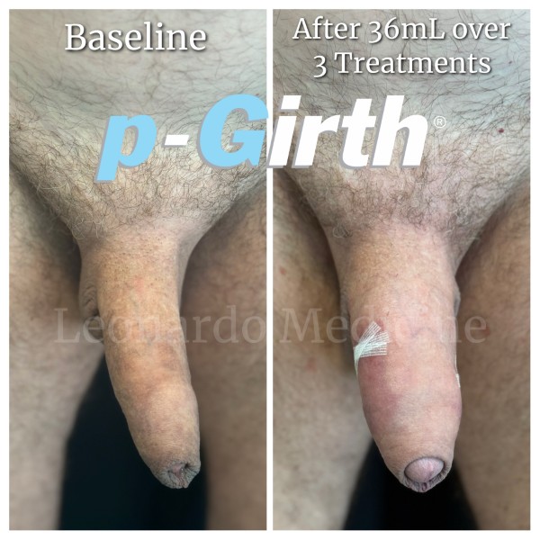 P-Girth® Uncircumcised penis augmentation case 5