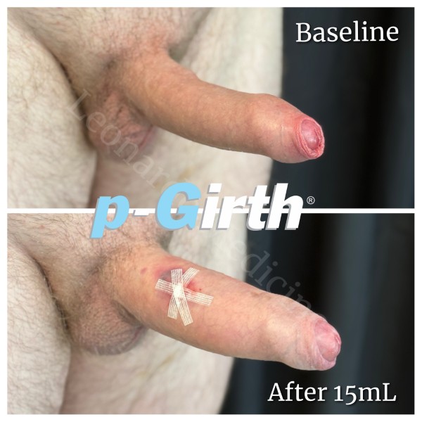 P-Girth® Uncircumcised penis augmentation case 6