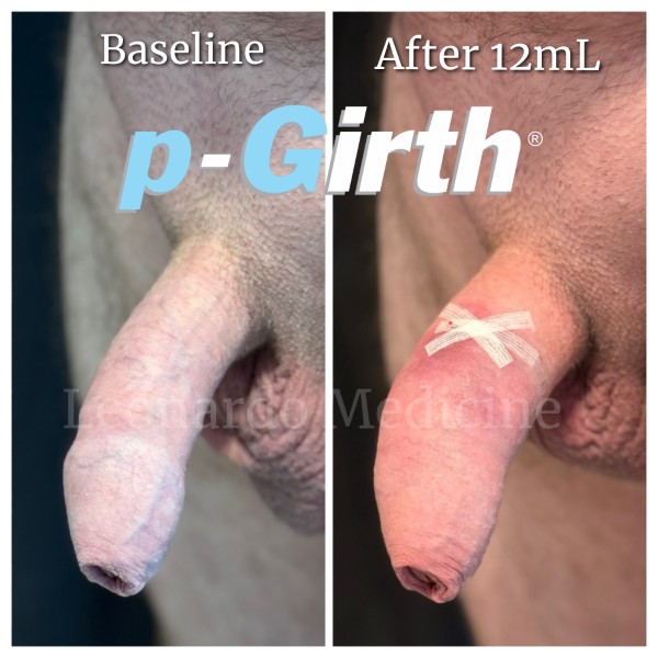 P-Girth® Uncircumcised penis augmentation case 7