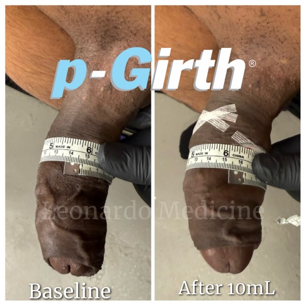 P-Girth® Uncircumcised penis augmentation case 8