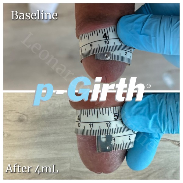 Glans augmentation treatment case 1