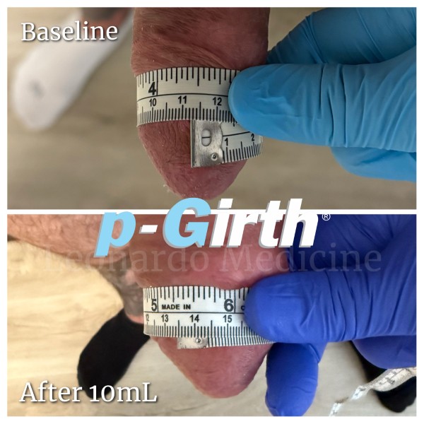 Glans augmentation treatment case 10