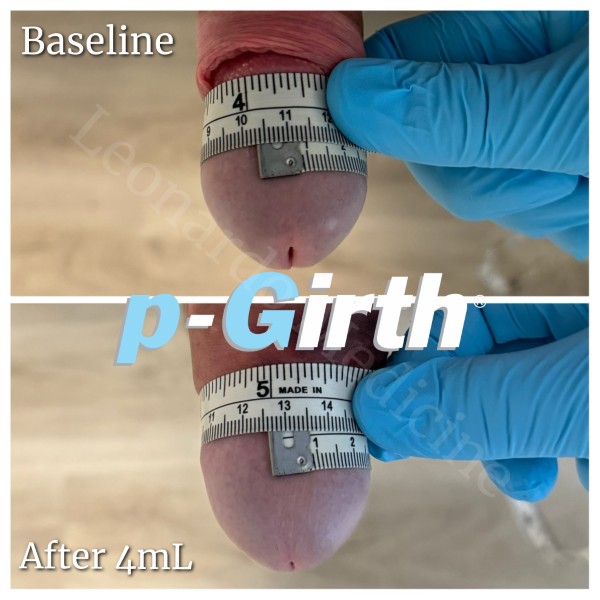 Glans augmentation treatment case 11