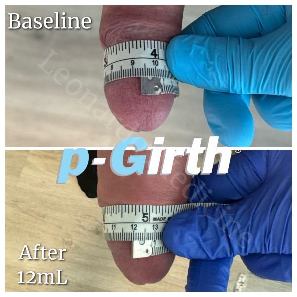 Glans augmentation treatment case 12