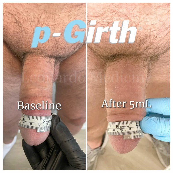 Glans augmentation treatment case 13
