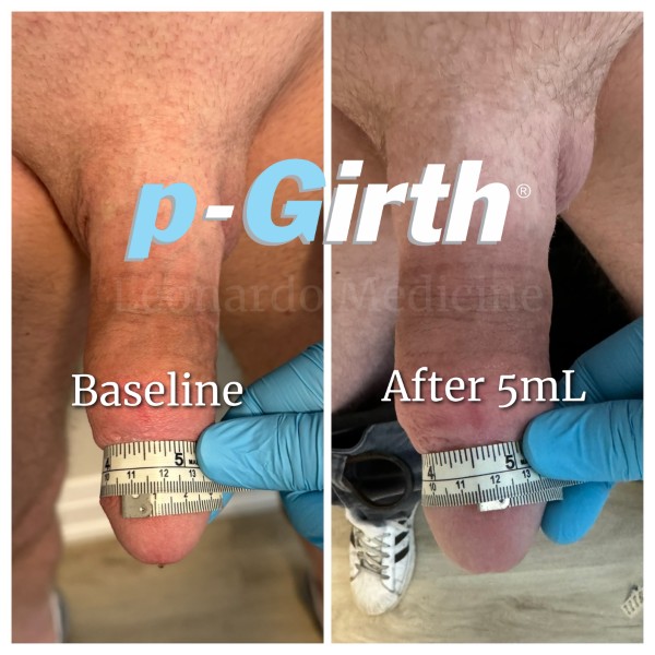 Glans augmentation treatment case 2