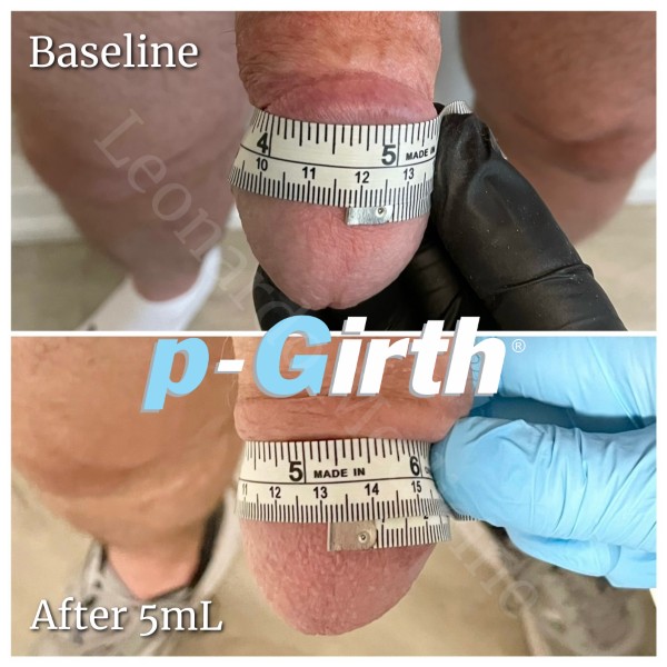 Glans augmentation treatment case 3