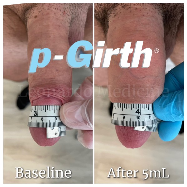 Glans augmentation treatment case 4
