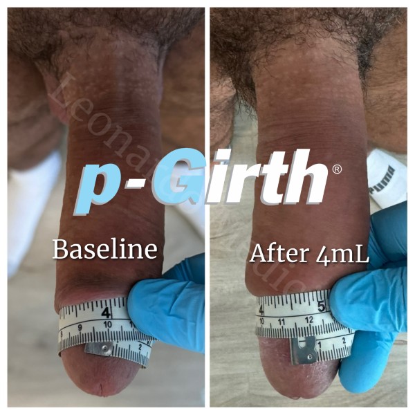 Glans augmentation treatment case 5
