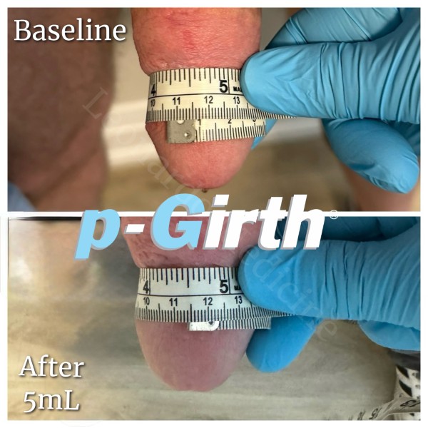 Glans augmentation treatment case 6