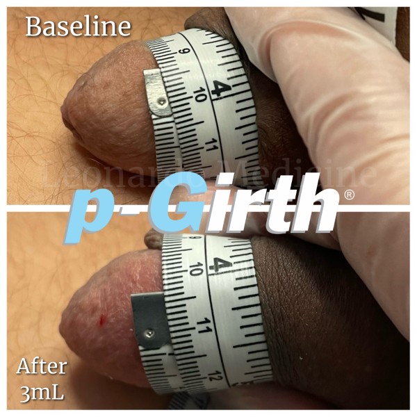 Glans augmentation treatment case 7