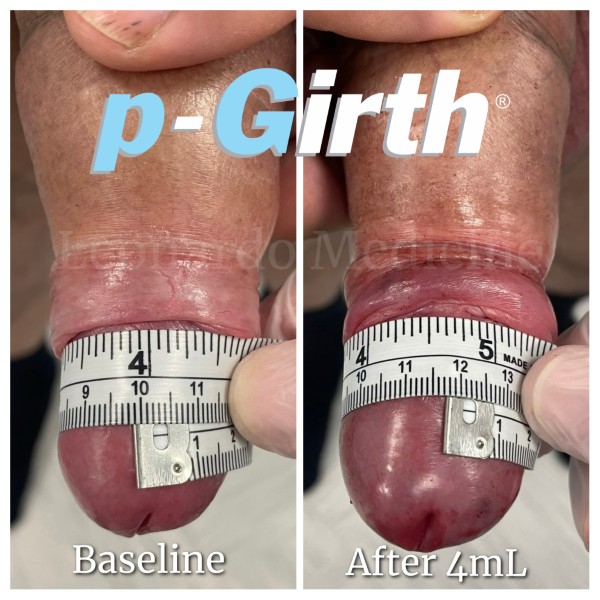 Glans augmentation treatment case 8