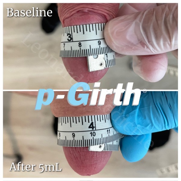 Glans augmentation treatment case 9