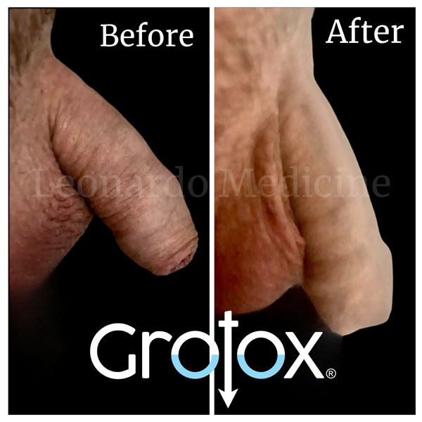 GroTox® treatment 1