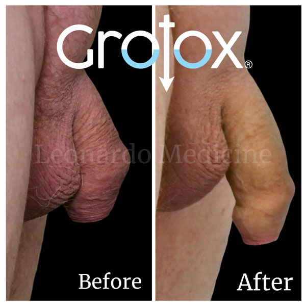 GroTox® treatment 10