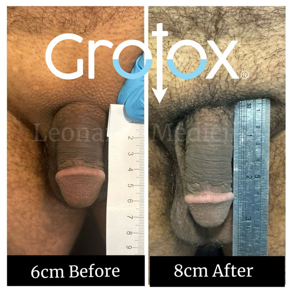 GroTox® treatment 13