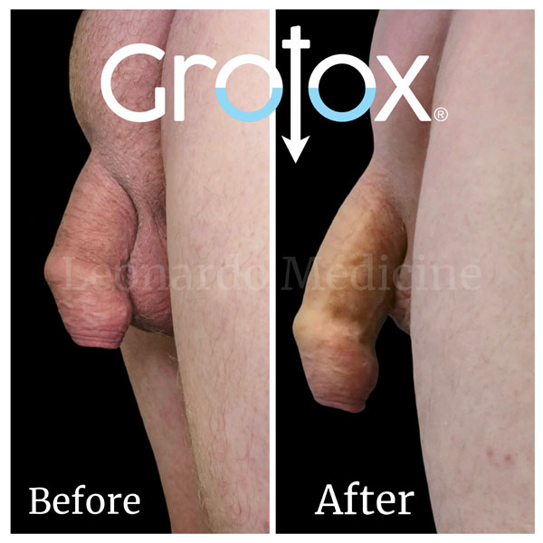 GroTox® treatment 14