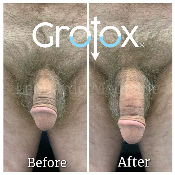 GroTox® treatment 15