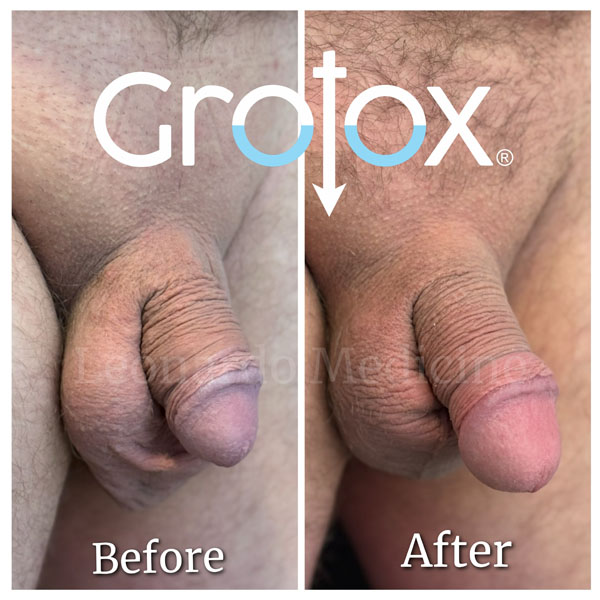 GroTox® treatment 17