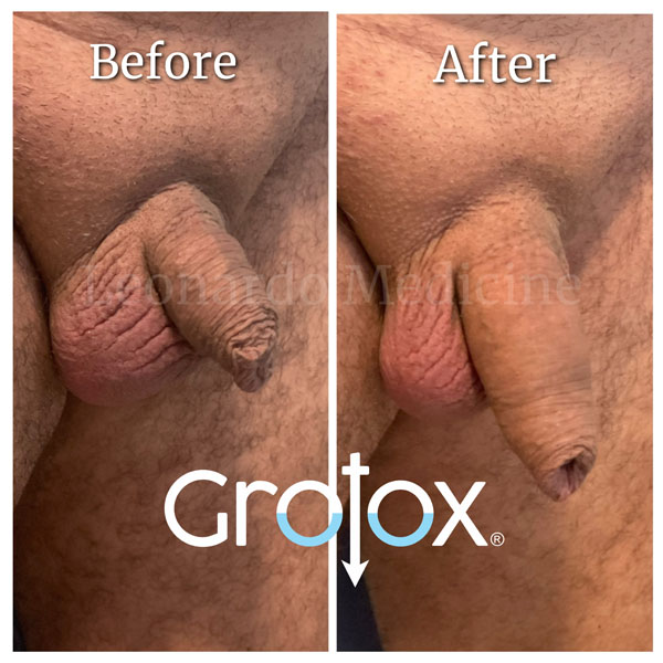 GroTox® treatment 2