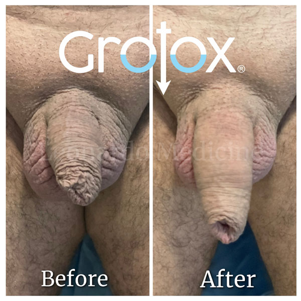 GroTox® treatment 22