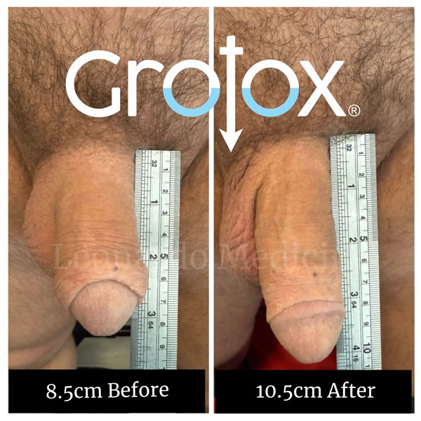 GroTox® treatment 23